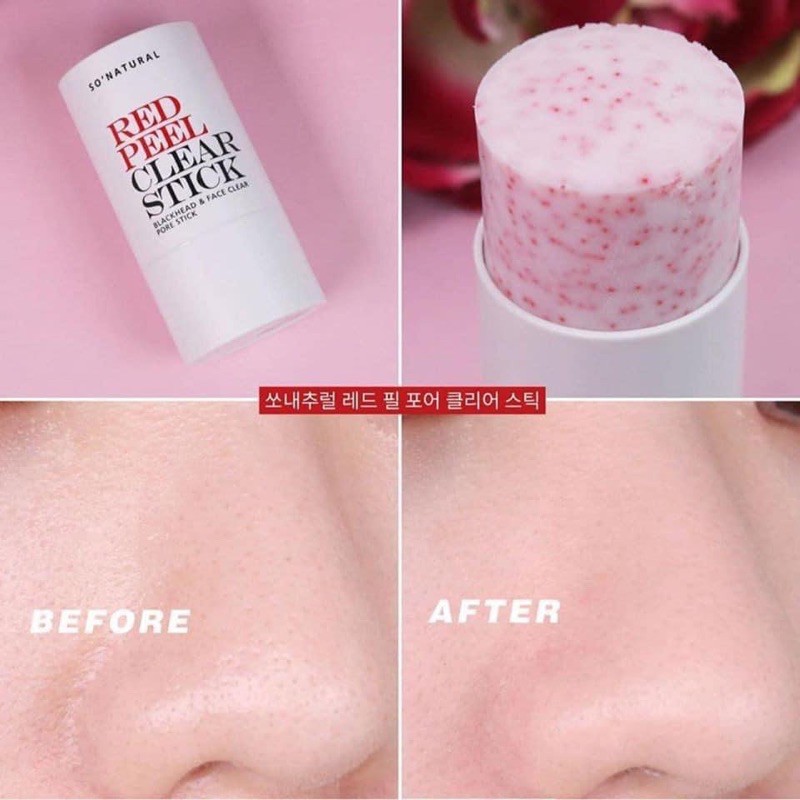 Thanh Lăn Làm Sạch Mụn Đầu Đen So’Natural Red Peel Clear Stick