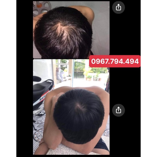 Advanced Trichology DHT Blocker Chống DHT - mọc tóc - giảm nhờn da đầu