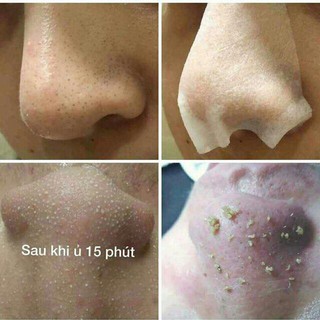 Ủ mụn Youngerc spa thẩm mỹ