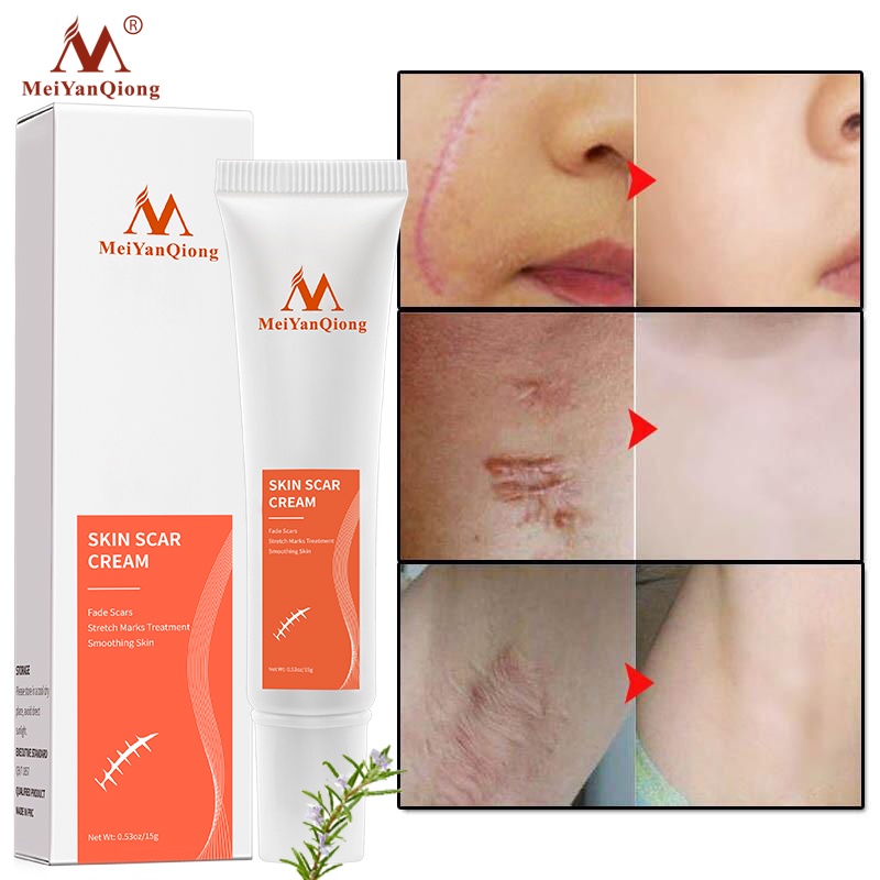 MeiYanQiong Acne Scar Removal Cream Skin Repair Stretch Marks giảm sẹo lồi, lõm, sẹo thâm, do mụn giúp phục hồi các tổn thương trên da thúc đẩy tái tạo da 15ml