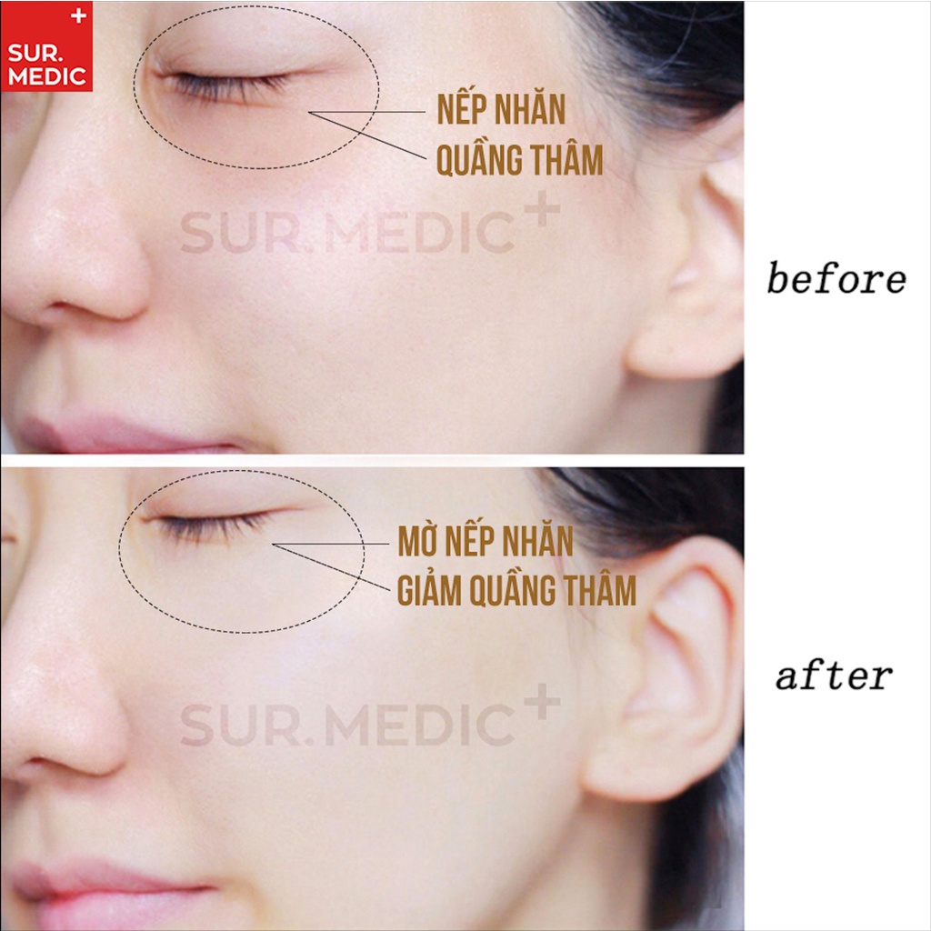 SUR.MEDIC+ Kem Dưỡng Mắt Chống Lão Hóa Cải Thiện Nếp Nhăn Vùng Mắt Sur.Medic Perfection 100™ All In One Facial Eye Cream