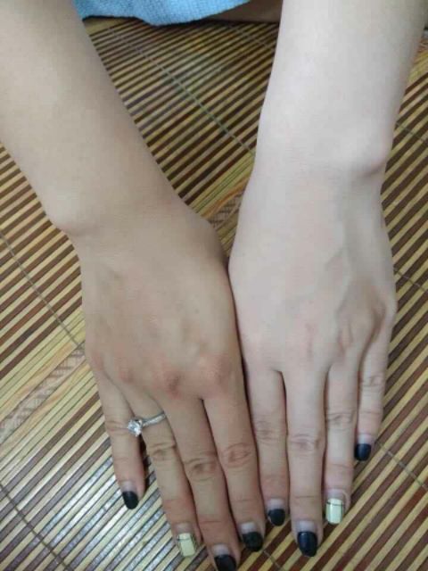 ( TRUYỀN TRẮNG AN TOÀN ) TRUYỀN TRẮNG NANO WHITE chính hãng | BigBuy360 - bigbuy360.vn