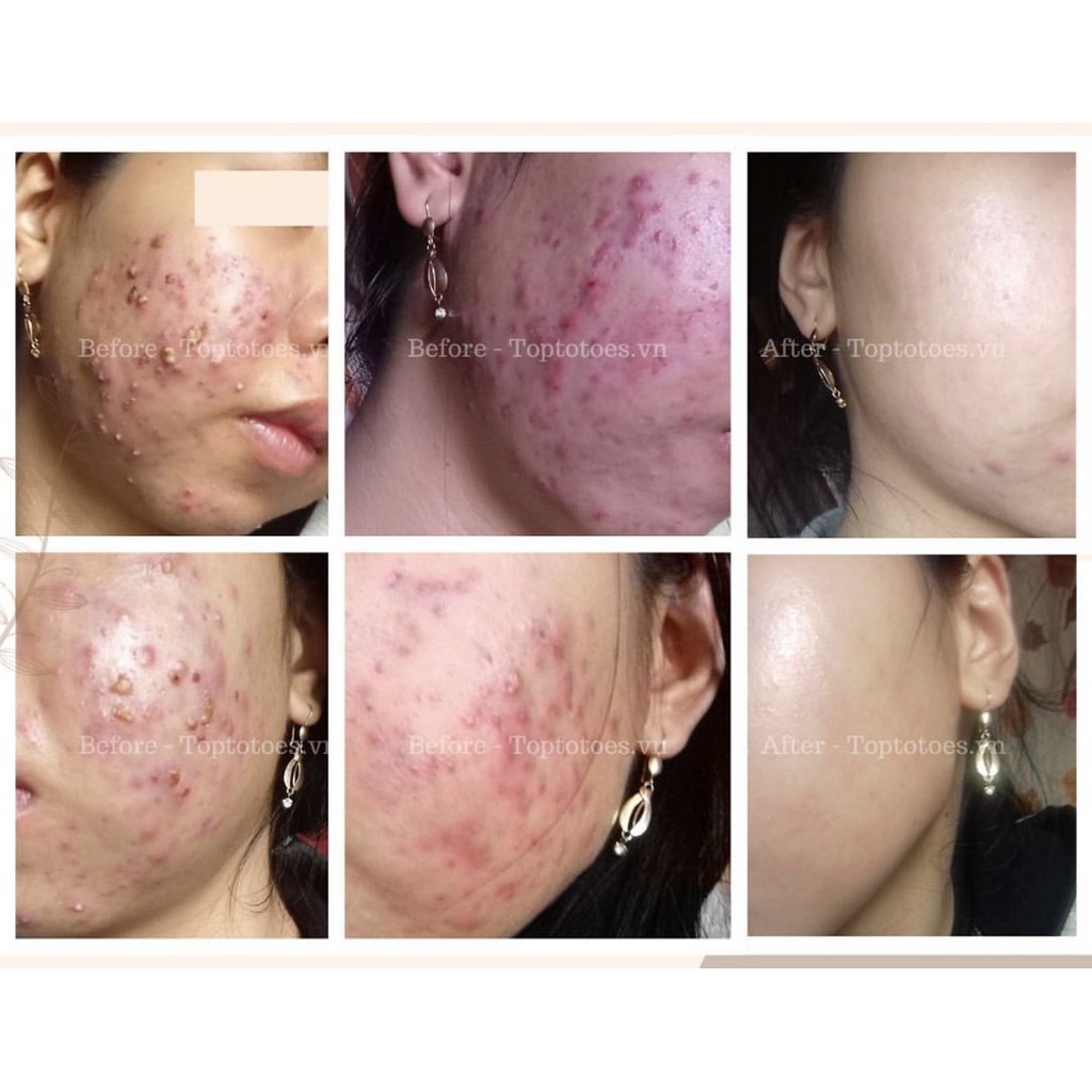 Serum Teana Anti-redness &amp; No Problem cho da mụn
