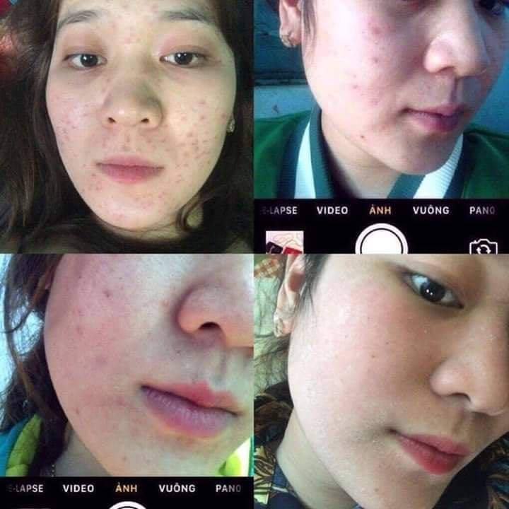 Kem nám tàn nhang kem trắng da Kem dưỡng da mặt 30g xóa vết thâm nám, tàn nhang làm mờ hắc tố, làm trắng da, săn chắc da tinh chất chất làm trắng da mặt chăm sóc