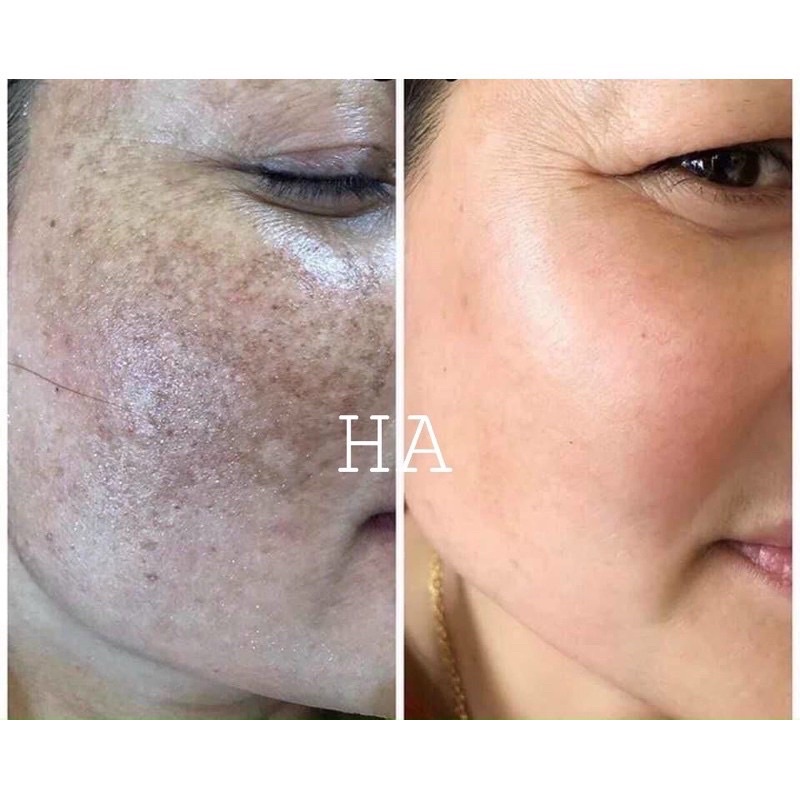 Serum OSAKURA số 2 skin Recovery xoá nám số 2