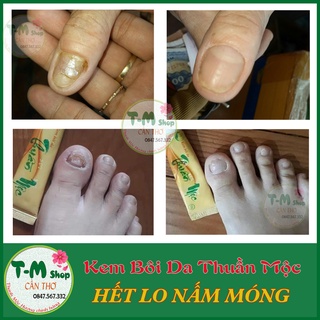 KEM BÔI DA LIỄU