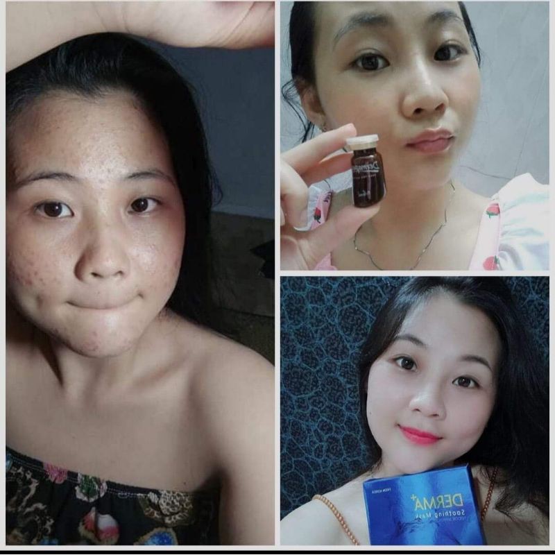 Combo Tảo Trứng Cá Tuyết Derma Peel+ - Tái Tạo Mô Da - Xóa Mụn - Thâm - Phục Hồi Da Hư Tổn - Tùy Chọn NẠ