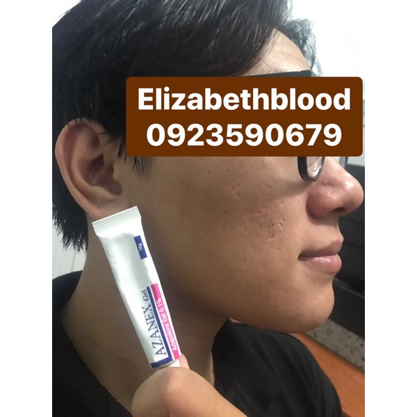 Gel bôi mụn cùng công thức với Differin Adapalene 0.1% dành cho da mụn ẩn mụn mủ viêm mụn đầu đen và da sần sùi | BigBuy360 - bigbuy360.vn