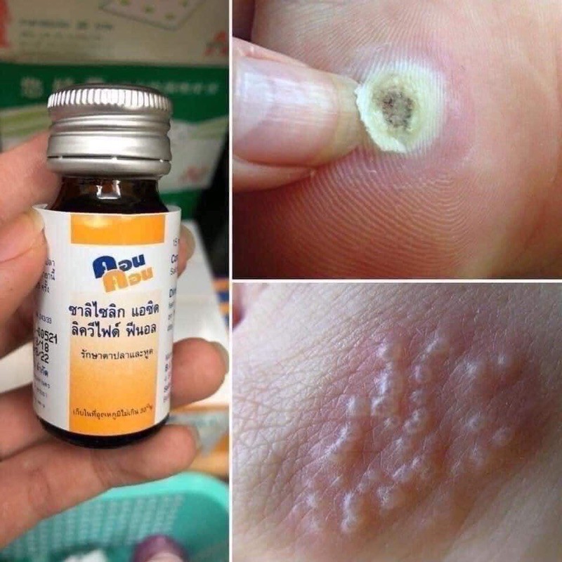 01 Dầu CON CON Bôi Mụn Cóc Thái Lan 15ml