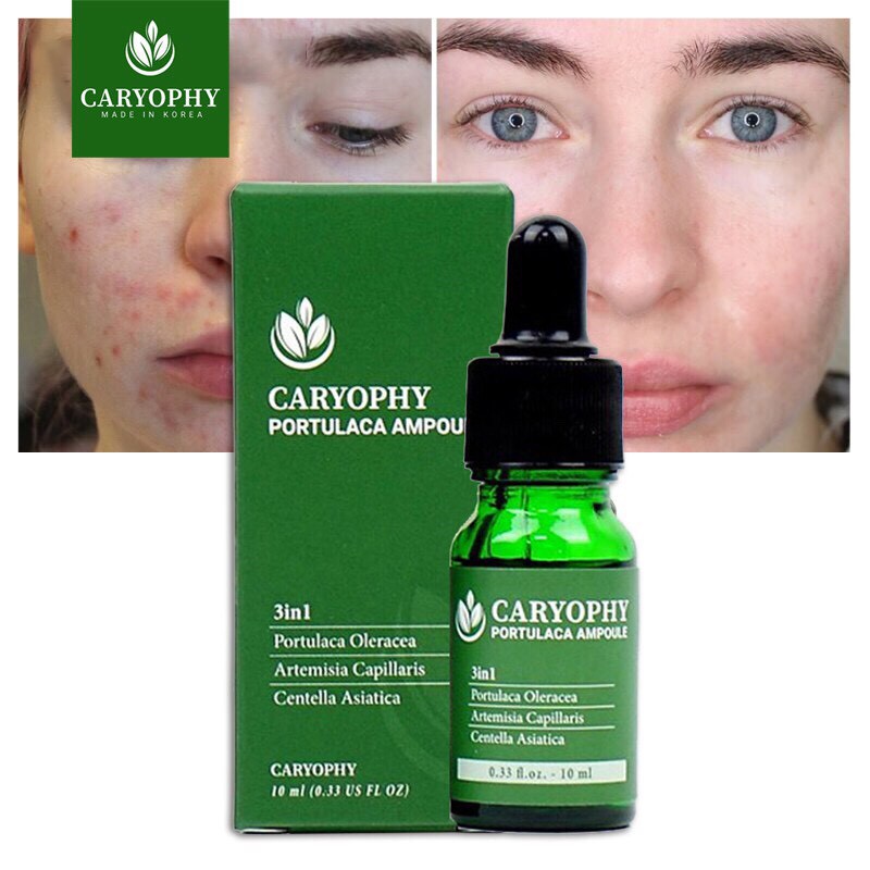 Combo làm sạch da, ngăn ngừa mụn và thâm Caryophy (Toner 300ml + Serum 10ml) | BigBuy360 - bigbuy360.vn