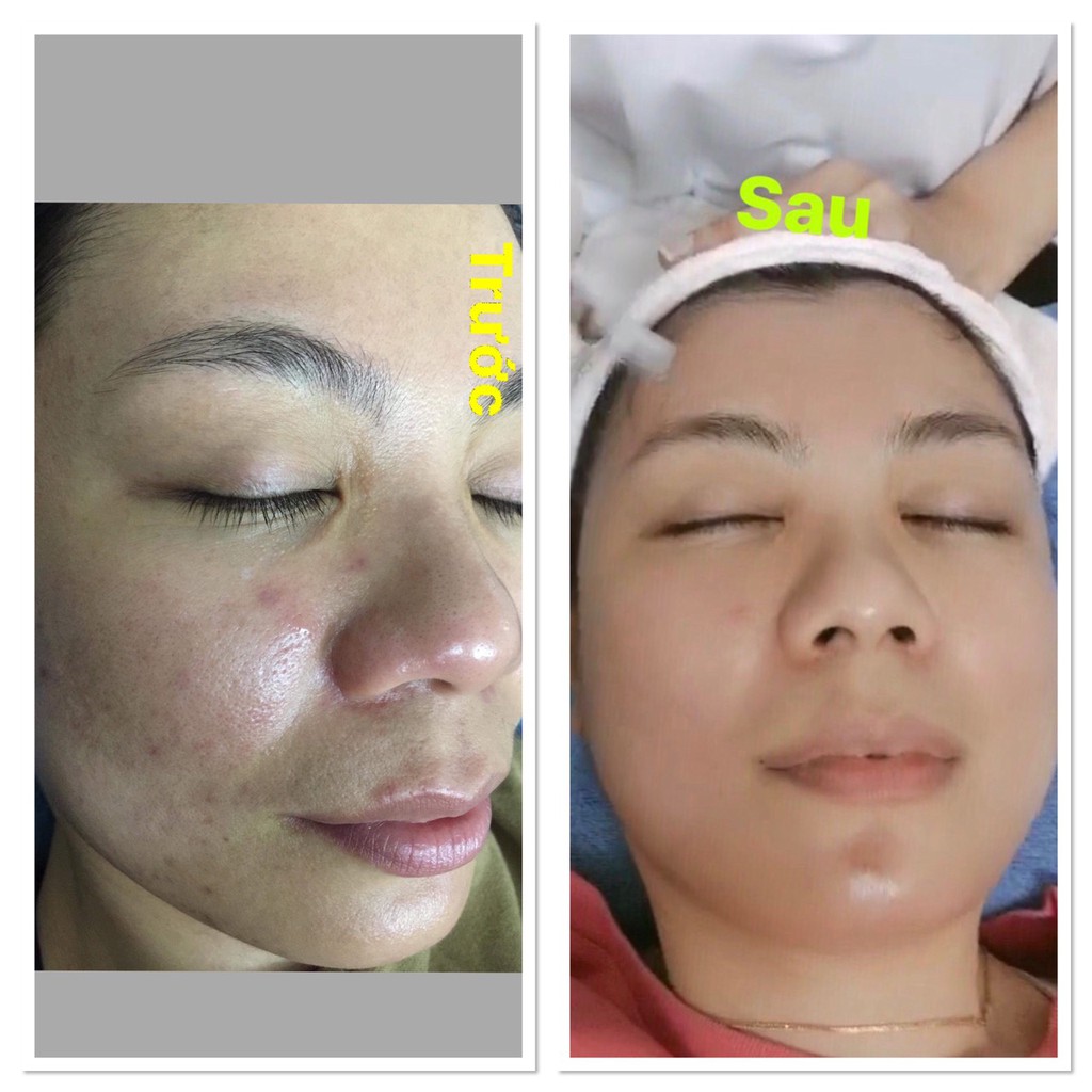 Serum giảm mụn thâm rỗ  Hana- Hiệu quả sau 1 tuần sử dụng (Đã được chứng minh tại rất nhiều Spa và nhà thuốc lớn)