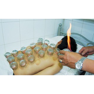 Bộ 12 ống giác hơi dùng lửa
