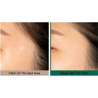 Miếng Dán Mụn Some By Mi Clear Spot Patch