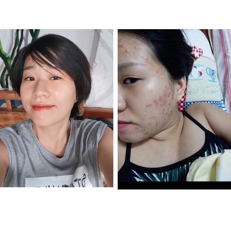 Serum mụn Nhà Bơ