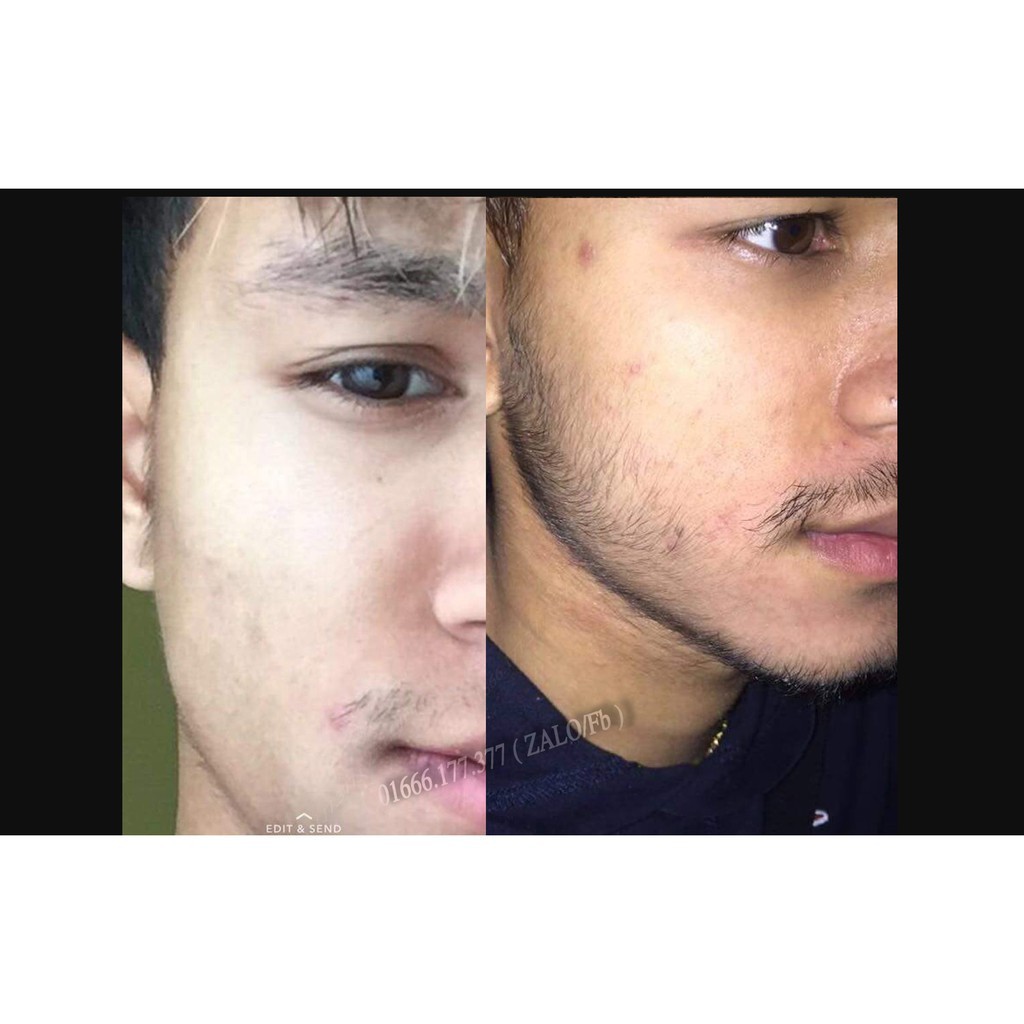 #FREESHIP - Combo Minoxidil 5% Kirkland  và Folic và Biotin - Thuốc mọc râu - Trị Hói