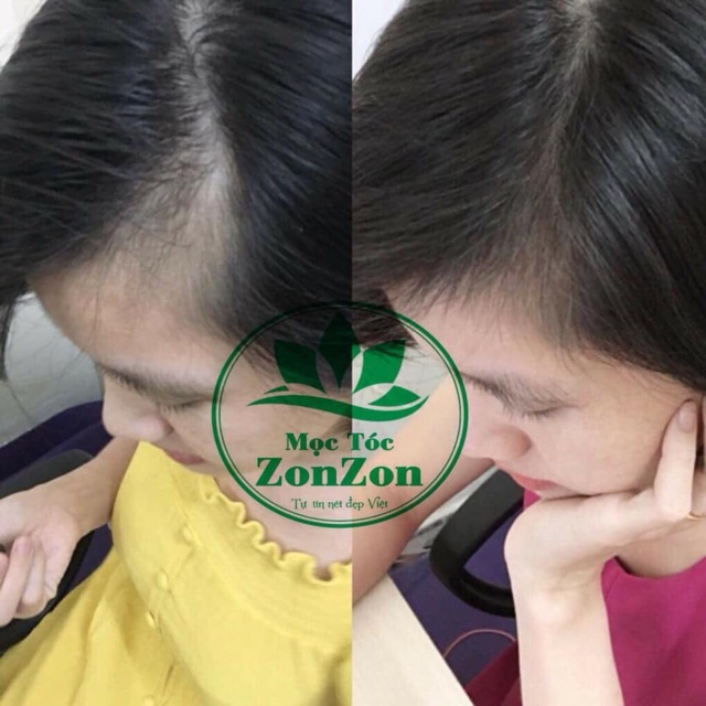 Tinh dầu mọc tóc ZonZon
