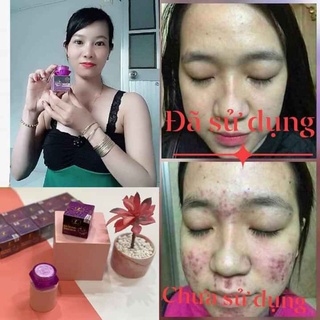 Combo 5 hộp face mụn