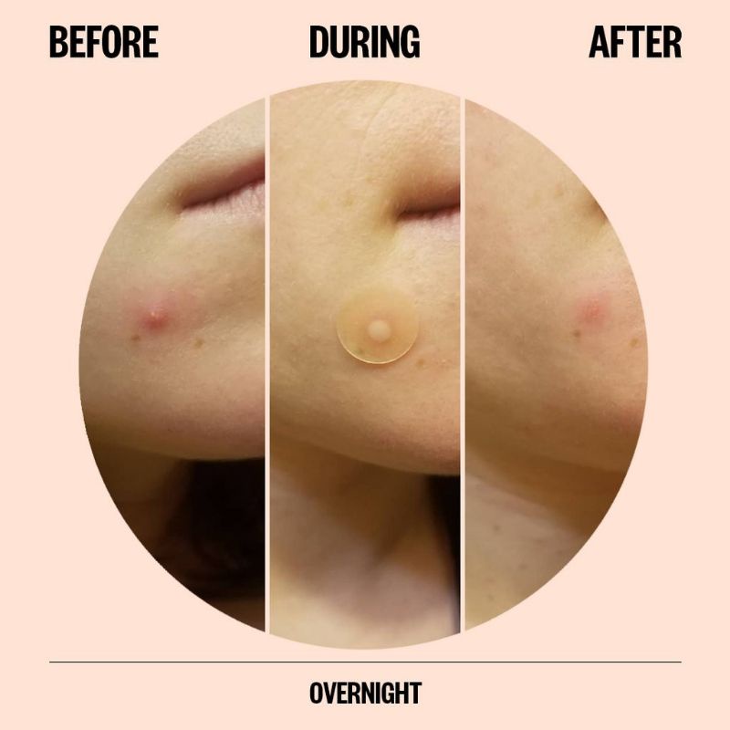 Miếng Dán Mụn Cực Hot PEACE OUT Salicylic Acid Acne Healing Dots