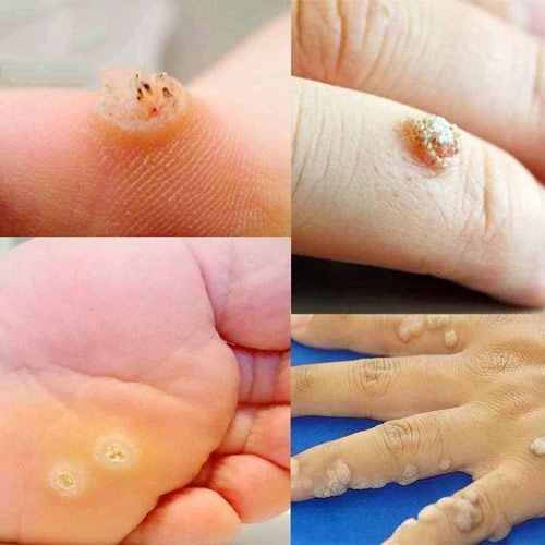 Dung Dịch Mụn Cơm Mụn Cóc Duofilm Của Đức - 15ml