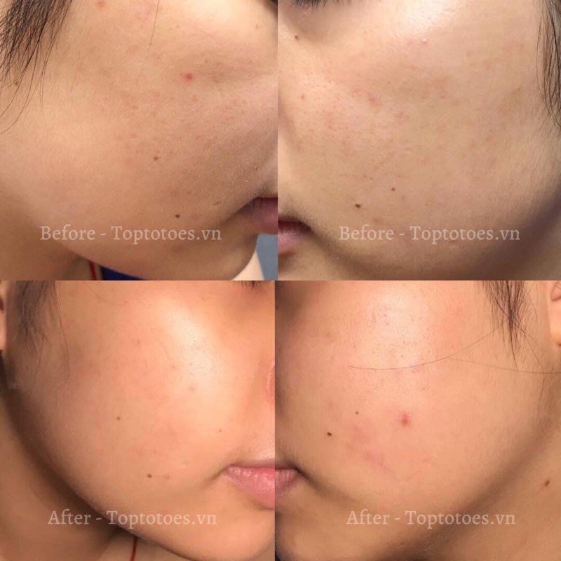 Serum Teana Super Peptides ASAP dưỡng trắng, mờ thâm, cải thiện kết cấu da