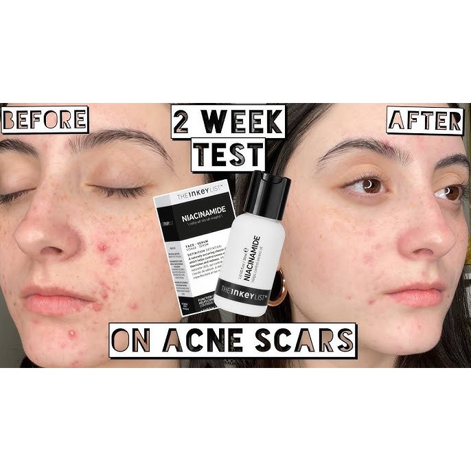 Serum Niacinamide - The Inkey List Cho Da Dầu Mụn, Giảm Thâm, Se Khít Lỗ Chân Lông 30ml