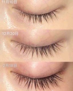 Kem mụn thịt Tsubuporon Nhật Bản