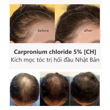 Carpronium chloride 5% [CH] ƙích mọc ṫóc, ġiảm hối đầu, bạch biến Nhật Bản