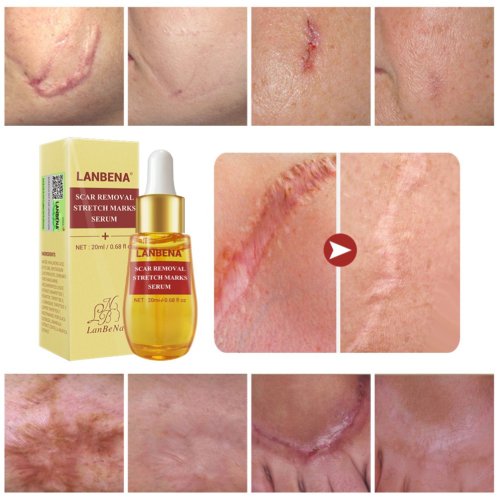 Set 2 Mỹ Phẩm Chăm Sóc Da LANBENA Gồm Serum Xóa Sẹo Mụn+Kem Làm Trắng Mụn Đầu Đen Thu Nhỏ Lỗ Chân Lông Làm Mờ Vết Rạn Da | BigBuy360 - bigbuy360.vn