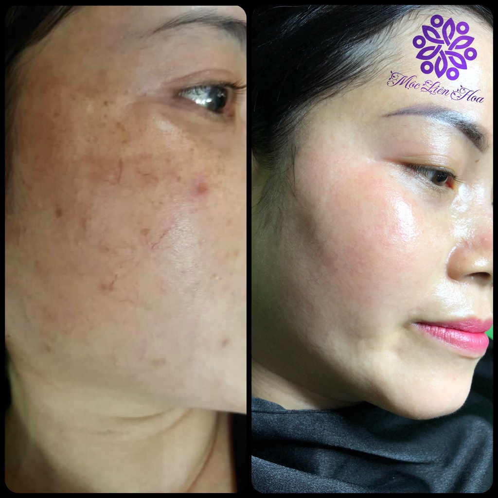 Kem K Quế Hoa Tailor Made Mộc Liên Hoa Ultra Spot 35g - Huda Shop