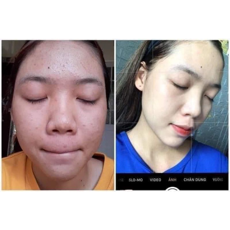 Sỉ 6 chai serum Hunie