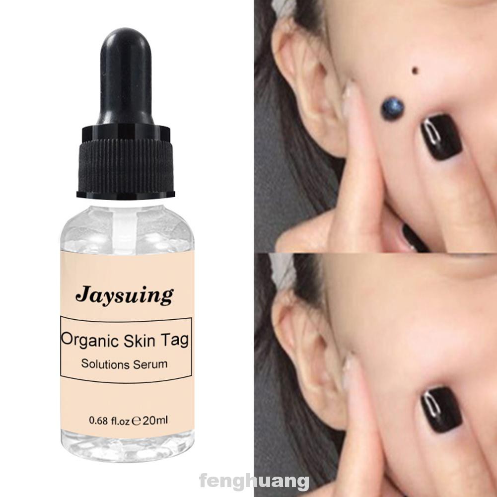 (Hàng Mới Về) Serum Trị Mụn Cóc Không Đau 20ml Tiện Dụng