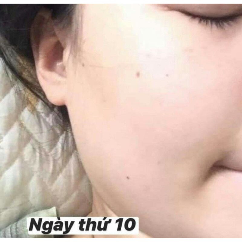 Tinh chất serum trị nám, tàn nhang trắng da ILYANG Hàn Quốc