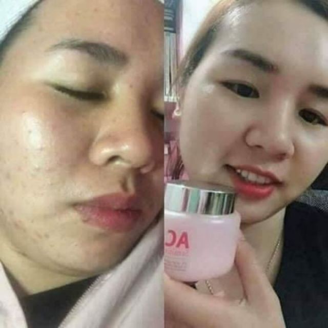 COMBO Dưỡng Da Khỏe, Sáng Căng Bóng Hỗ Trợ Điều Trị Mụn Giảm Sưng Skinaz  [Chính Hãng]