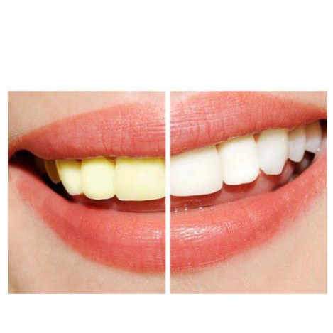Tẩy Trắng Răng tại nhà Opalescence 10% 15% 20% 35%