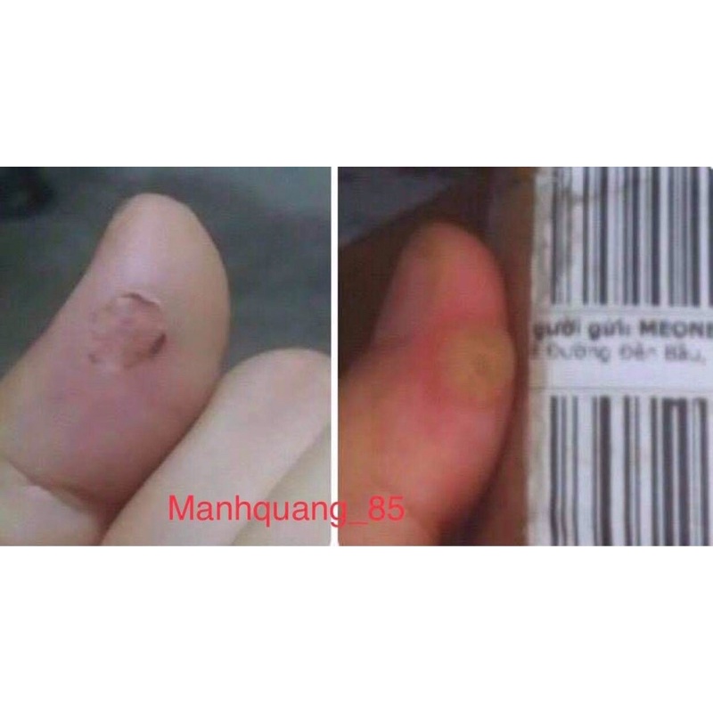 Tẩy xoá nốt ruồi,tàn nhang,mụn cóc,mụn thịt ,mụn cơm, mắt cá | BigBuy360 - bigbuy360.vn