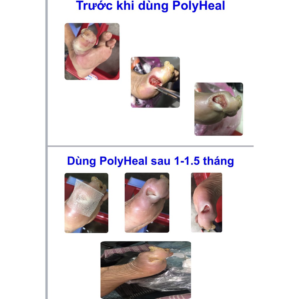 Polyheal Micro 7,5mL- Siêu vi cầu thúc đẩy lành thương