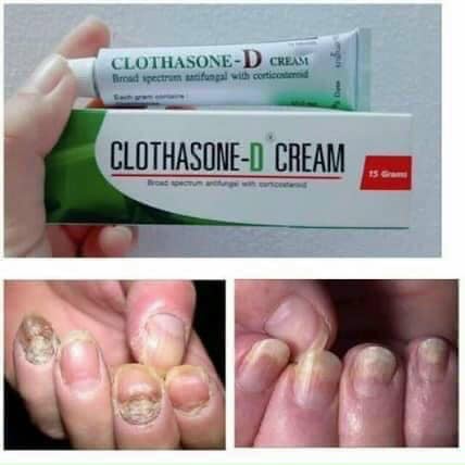 Kem bôi nấm móng CLOTHASONE-D CREAM 15g