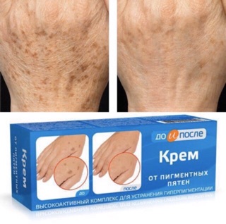 Kem trị đồi mồi nga