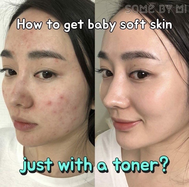 ( Sẵn ) Toner mụn 30 ngày Some By Mi AHA-BHA-PHA 30 Days Miracle Toner | BigBuy360 - bigbuy360.vn
