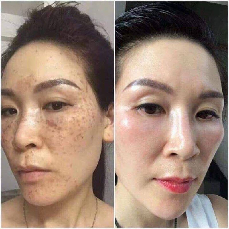 Thảo dược nhân sâm chuyên mụn , thâm , nám , se khít lỗ chân lông , trắng da combo mua 4 tặng 1 handmade