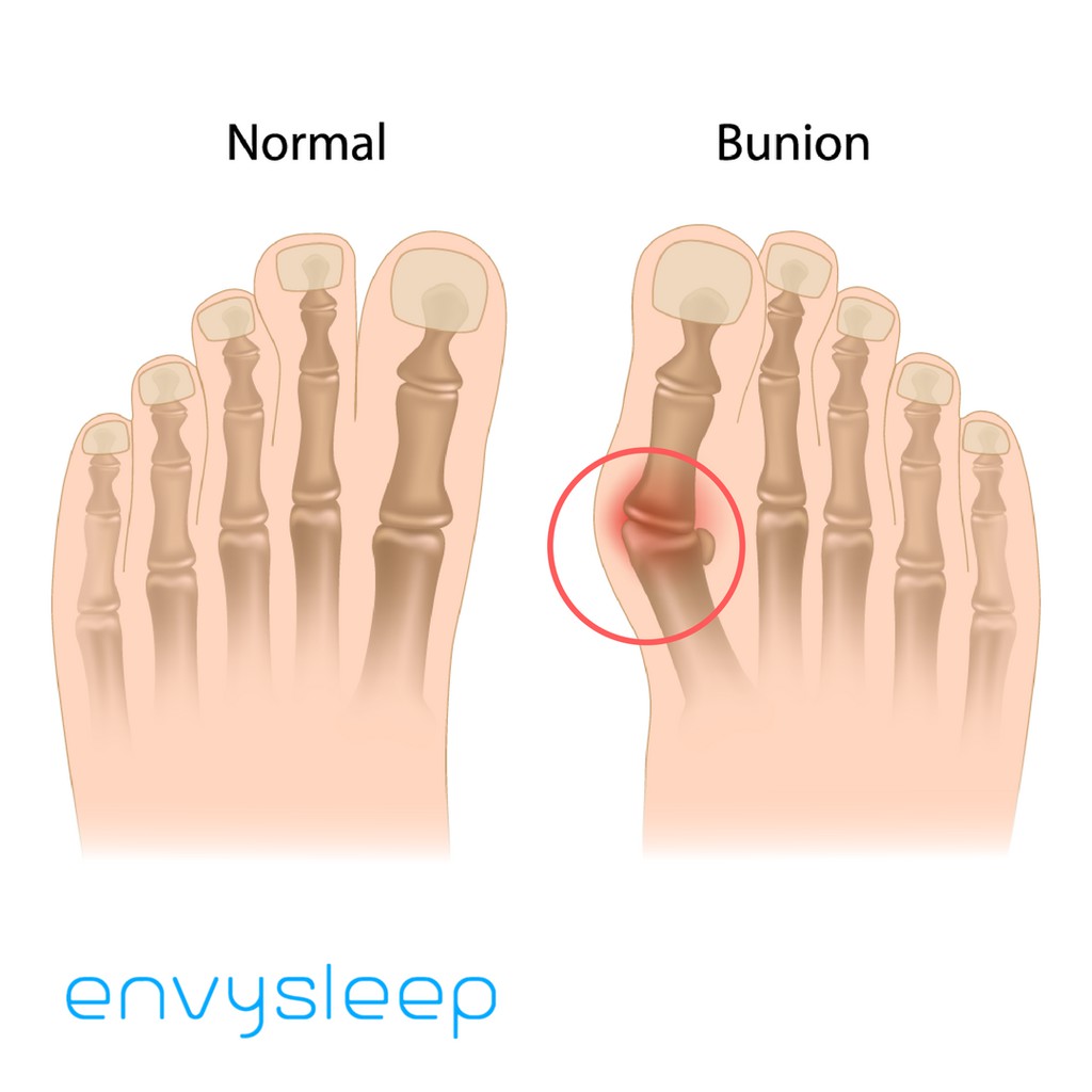 Lót giày Silicon đệm ngón, ôm chân Envysleep - NGÓN CHÂN CÁI BIẾN DẠNG BUNIONS