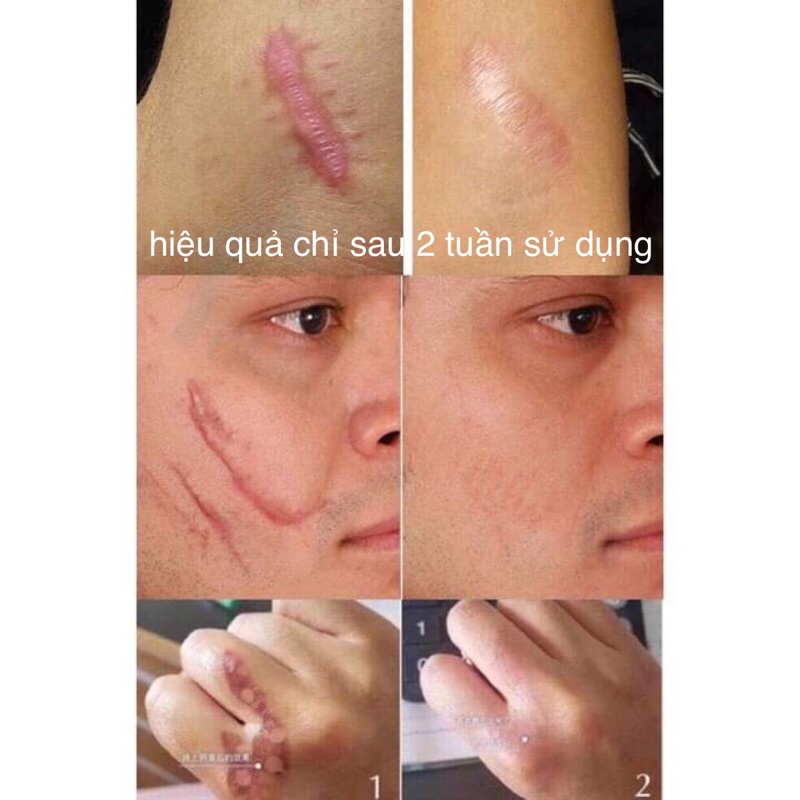 [CHÍNH HÃNG] Kem Xóa Sẹo Thâm / Rỗ / Lõm , Gel Hỗ Trợ Giảm Sẹo - Strataderm 10g | BigBuy360 - bigbuy360.vn