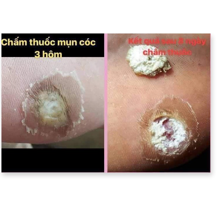 Chấm Mụn Cóc Tại Nhà Hết Mụn Mắt Cá‎ Mụn Cơm Acid-Trichloracetic 80% - Chai 15ml thuoc cham mun coc [AnhThư Boutique] | BigBuy360 - bigbuy360.vn