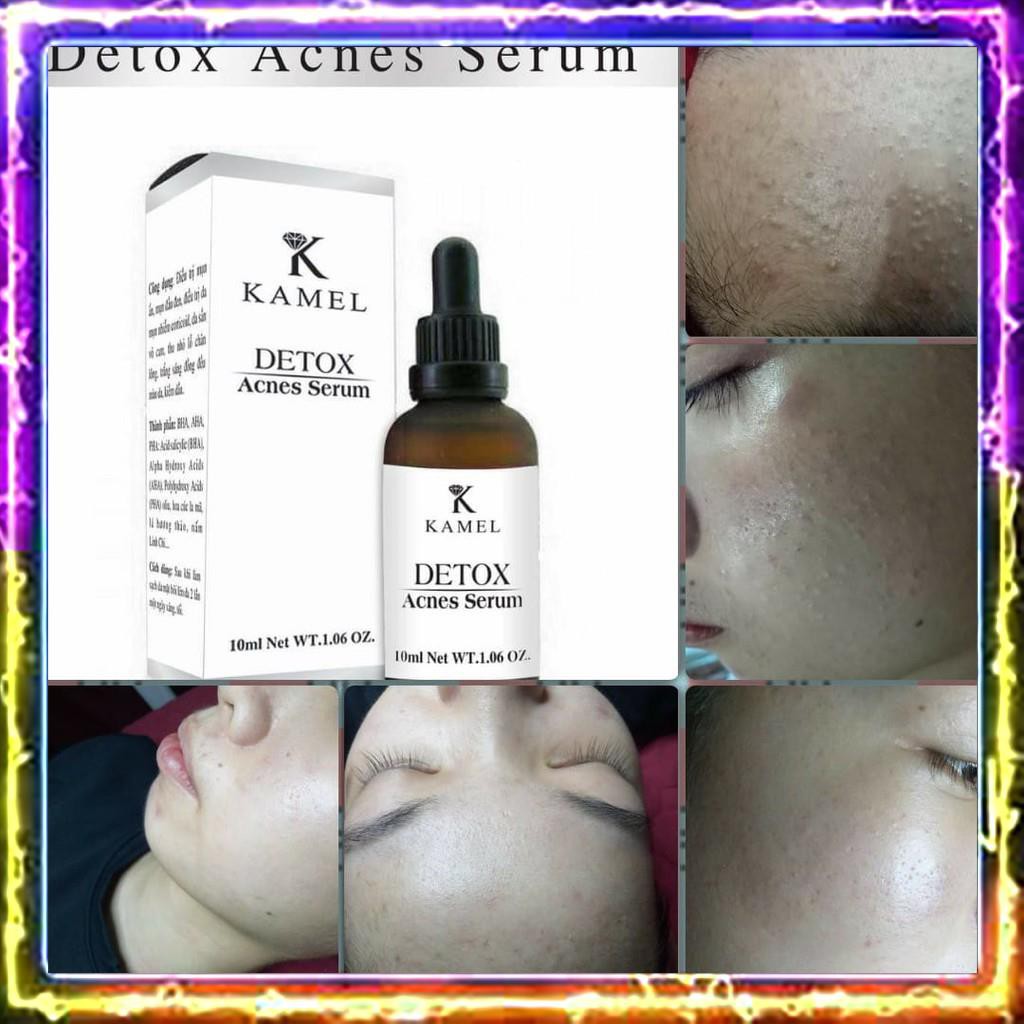 [Sẵn hàng] Detox Acnes Serum - Serum loại bỏ mụn Kamel 10ml | BigBuy360 - bigbuy360.vn
