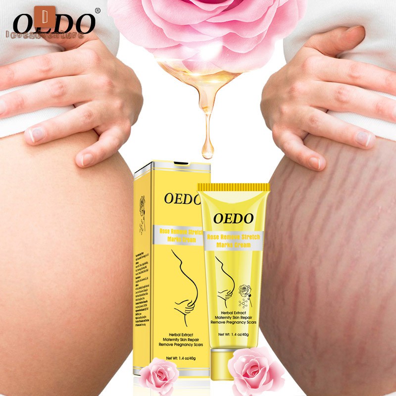 Kem trị rạn da tinh chất hoa hồng cho phụ nữ mang thai nhãn hiệu OEDO