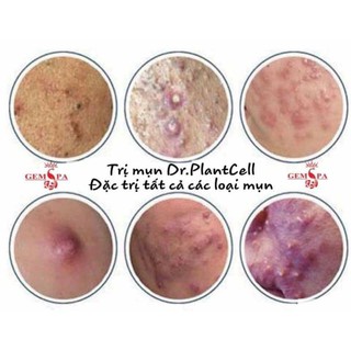 Tiêu cồi mụn 24h