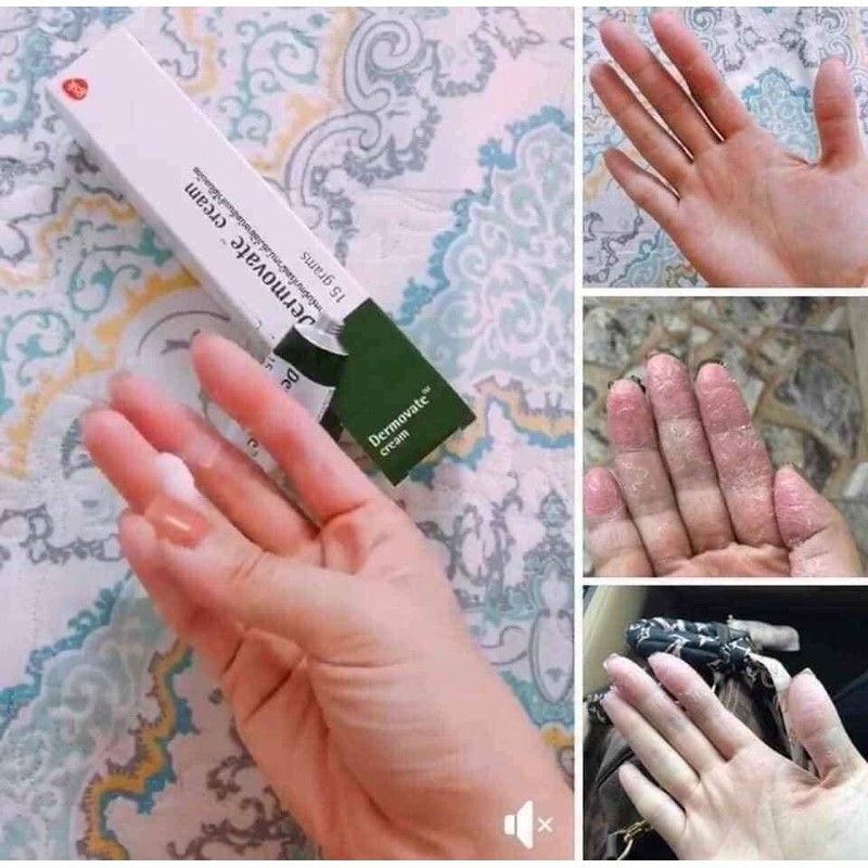 [CHỈ BÁN HÀNG THÁI] KEM VẢY NẾN,Á SỪNG,VIEM DA THÁI LAN[SẴN][FREESHIP][CHUẨN HÀNG][BẢO HÀNH 7 NGÀY] | BigBuy360 - bigbuy360.vn