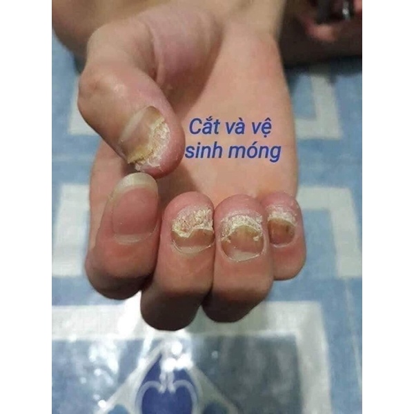 Kem bôi nấm móng tay, chân Thái Lan