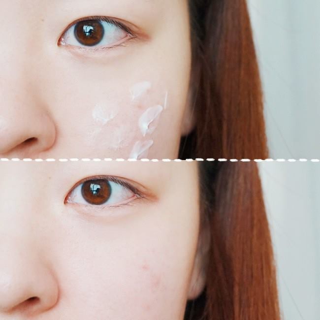 Kem Pair Acne Hỗ Trợ Làm Giảm Và Loại Bỏ Mụn Nhật Bản