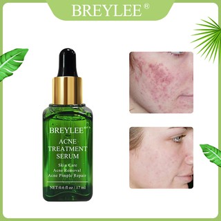 Serum Hỗ Trợ Giảm mụn BREYLEE 17ml